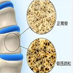 【骨密度分析儀科普】骨密度指標對照表，人手一份