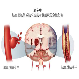 檢查腦卒中不要怕-經(jīng)顱多普勒看透你的腦