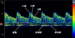 經(jīng)顱多普勒檢查參數(shù)介紹