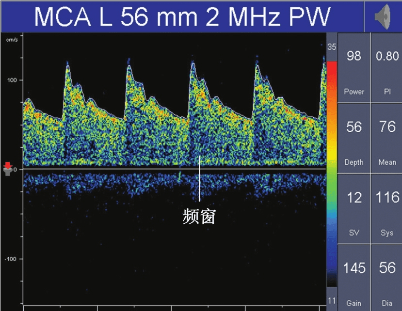 TCD多普勒正常血流頻譜可見(jiàn)頻窗